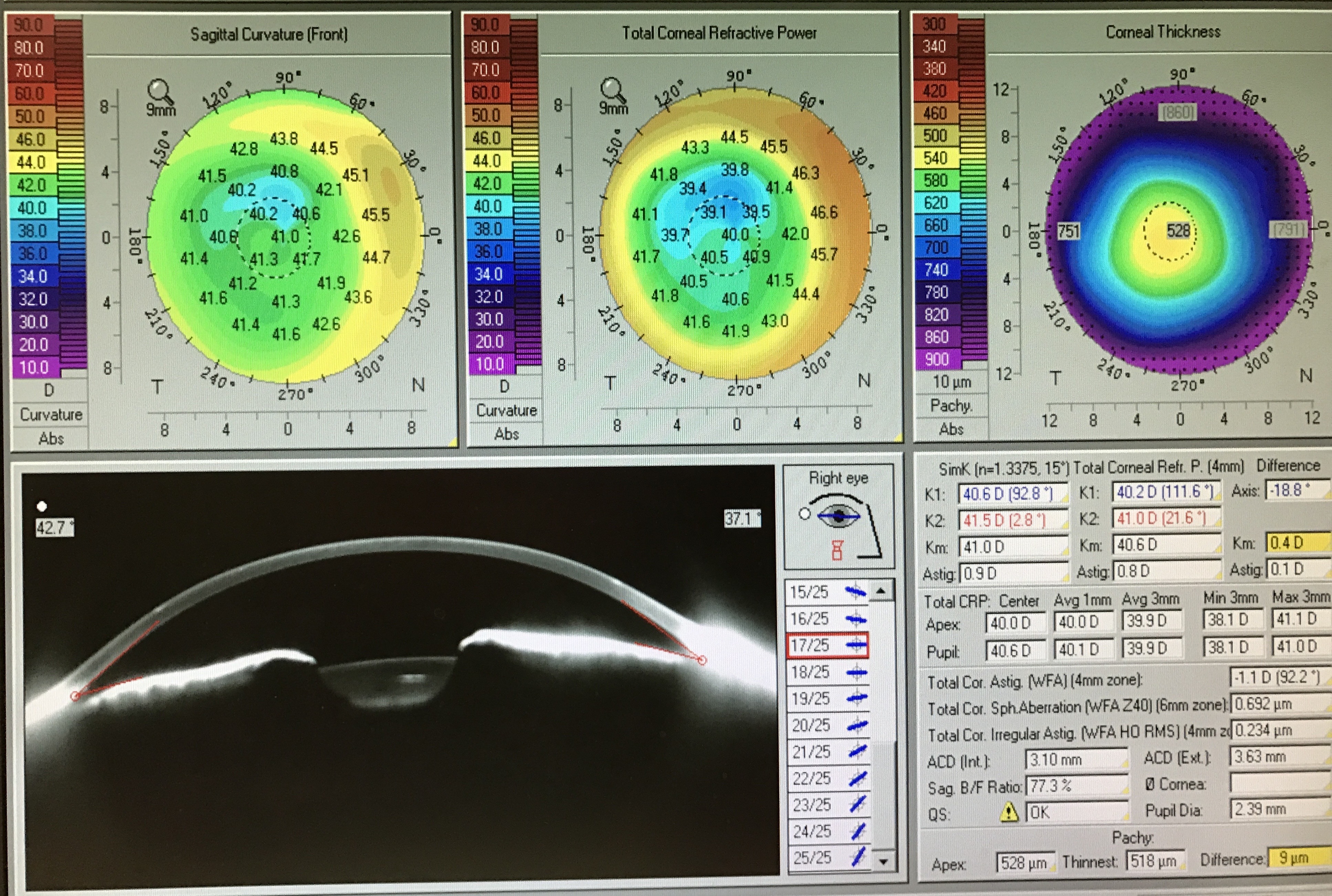 corneal transplant dallas tx