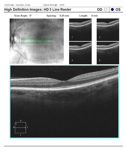 Retinal Eye Exam in Dallas, TX | Infinity Vision Dallas