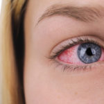 Eye Conditions Dallas, TX