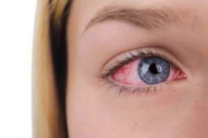 Eye Conditions Dallas, TX